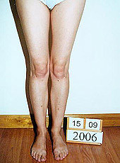 Results of treatment