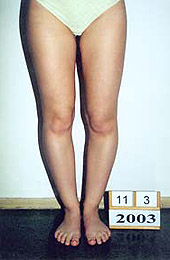 Genu varum. Before the treatment