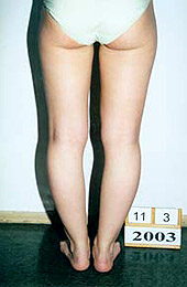 Genu varum. Before the treatment