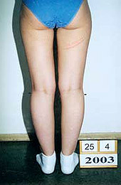 After the surgery