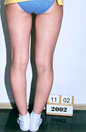 Genu varum. Before the treatment