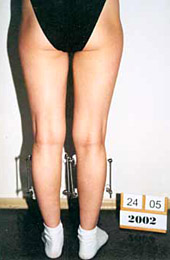 After the surgery