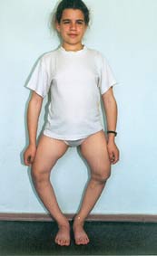Genu varum. Before the operation