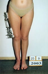 After the surgery. Lengtheningof the femur on 1,6 inches.
