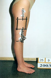 After the surgery. Lengtheningof the femur on 1,6 inches.