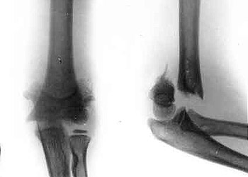 Fracture of humeral bone.