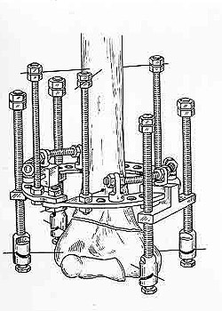 Osteosynthesis of upper arm by means of Veklich's apparatus.