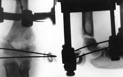 Osteosynthesis of upper arm by means of Veklich's apparatus.