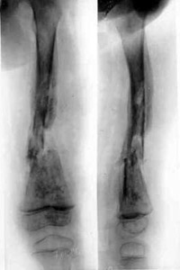 Osteomyelitis of left hip.