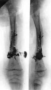 Osteomyelitis of left hip.