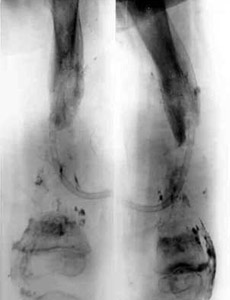 After operation.