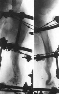Treatment by means of Ilizarov's apparatus.