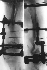 Treatment by means of Ilizarov's apparatus.