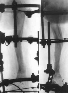 Treatment by means of Ilizarov's apparatus.