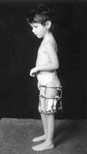 Patient in Ilizarov's apparatus.