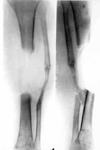 Defect of middle/third of spin-bone.