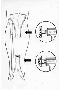Mechanical treatment of spin-bone by half-spheric mills.