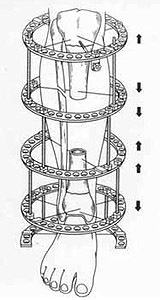Osteosynthesis by means of Ilizarov's apparatus. 