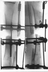Replacement phase of spin-bone's defect