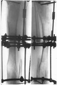 Joining fragments of spin-bone with electrostimulation and osteoreparation.