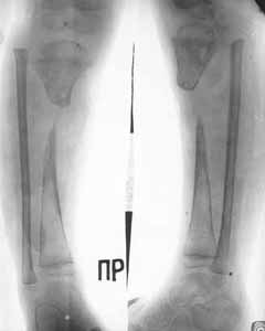 Defect of upper/third of shin-bone after hematogenous osteomyelitis. 
