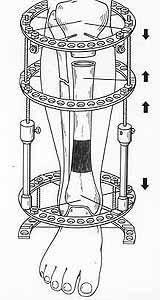 Replacement phase of the defect by means of Ilizorov's apparatus.