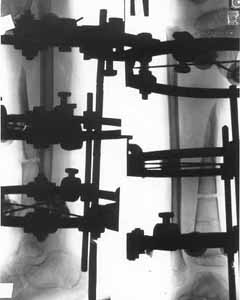 Replacement phase of the defect by means of Ilizorov's apparatus.