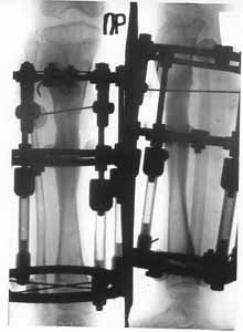 Joining fragments of spin-bone with electrostimulation and osteoreparation.