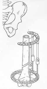 Ablation of upper part of hip crossing with lower/third in a Ilizarov's apparatus. 