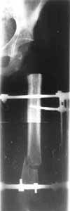 Ablation of upper part of hip crossing with lower/third in a Ilizarov's apparatus. 