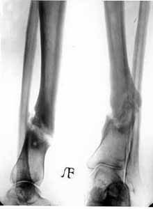 False joint of lower/third of shinbone.
