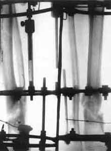 Osteosynthesis with elimination of deformations and electrostimulation(period of treatment - 3 monthes). 