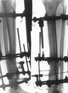 Osteosynthesis with elimination of deformations and electrostimulation(period of treatment - 3 monthes). 