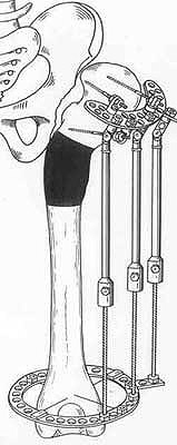 Schanz-Ilisarov's operation with elongation of hip.