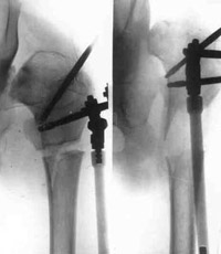 Schanz-Ilisarov's operation with elongation of hip.