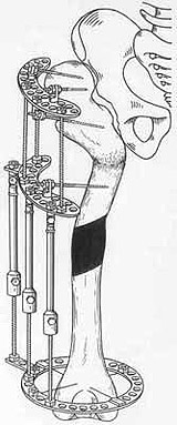 Schanz-Ilisarov's operation with elongation of hip.