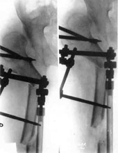 Schanz-Ilisarov's operation with elongation of hip.