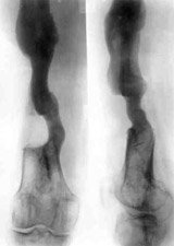 Consequences of tumour of right hip.