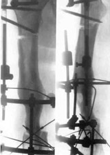 Replacement of nonviable tissues of lower/third of hip with elongation of hip by means of Ilisarov's apparatus.