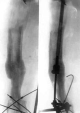 Replacement of nonviable tissues of lower/third of hip with elongation of hip by means of Ilisarov's apparatus.