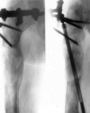 Replacement of nonviable tissues of lower/third of hip with elongation of hip by means of Ilisarov's apparatus.