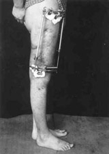 Patient in Ilisarov's apparatus.