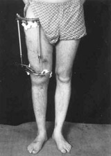 Patient in Ilisarov's apparatus.