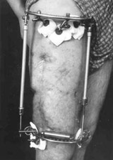 Patient in Ilisarov's apparatus.