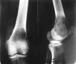 Tumour of lower/third of thigh-bone.