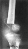 Removal of tumour.