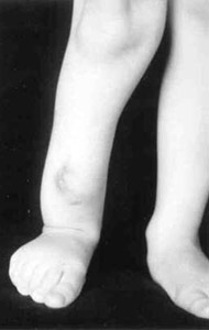 Congenital false joint of the bones of left shin.