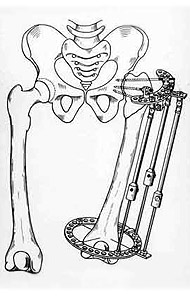 Closing of hip joint with elongation of hip.