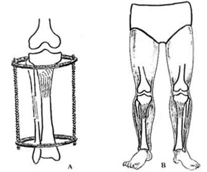 Limb lengthening. 